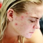 Eliminar el acné con Aerolase: ¿Funciona realmente?