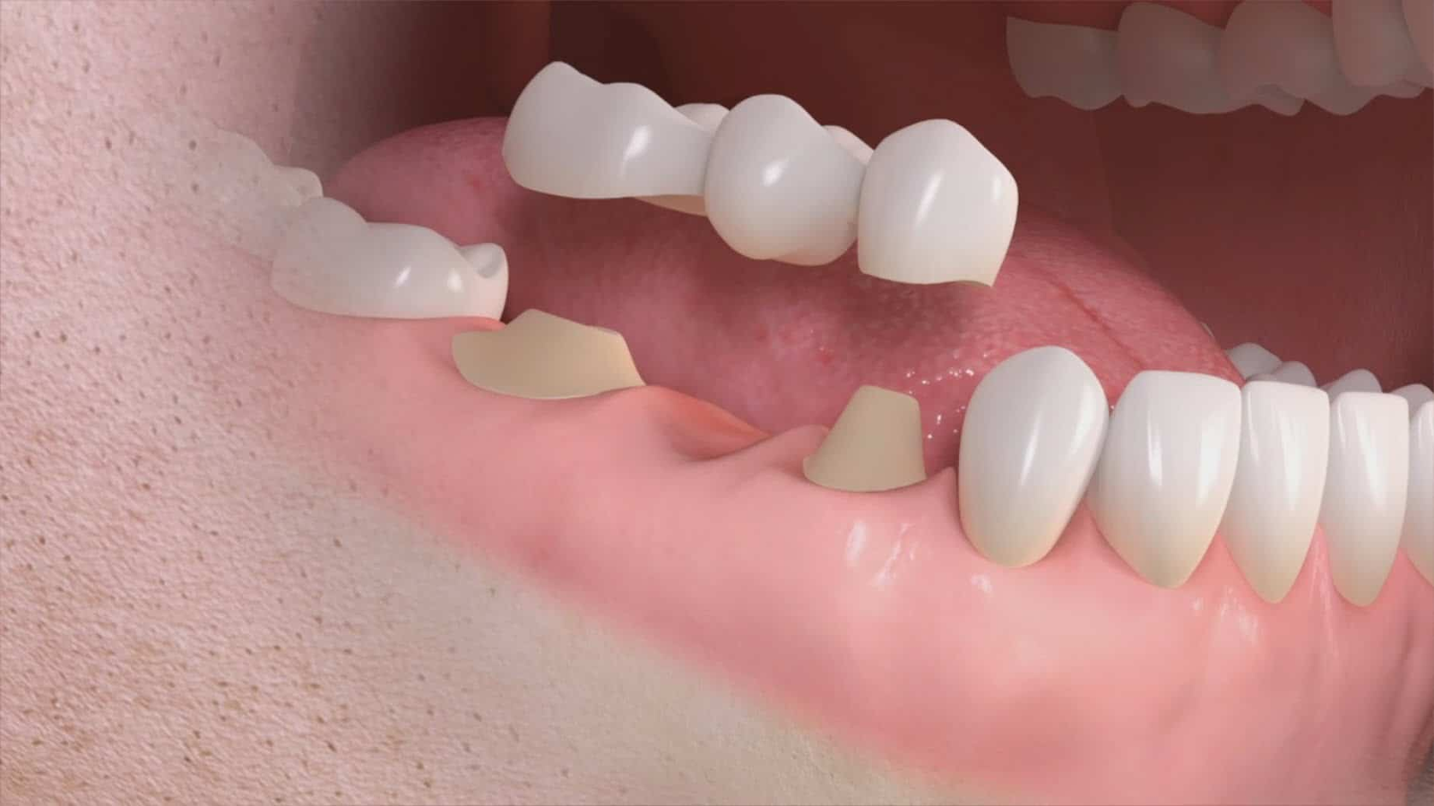 Cómo mejorar tu apariencia y sonrisa con prótesis dentales
